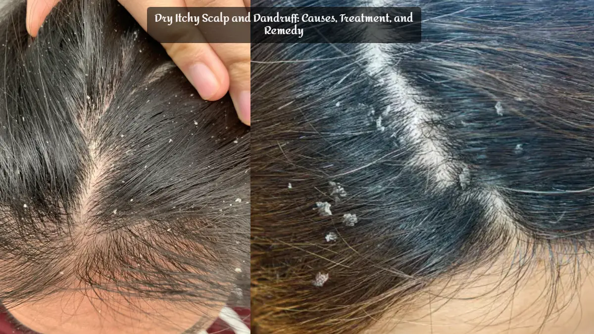 Dry Itchy Scalp And Dandruff: Causes, Treatment, And Remedy