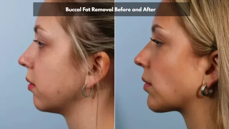 Buccal Fat Pad Removal: Cost, Benefits & Transformation