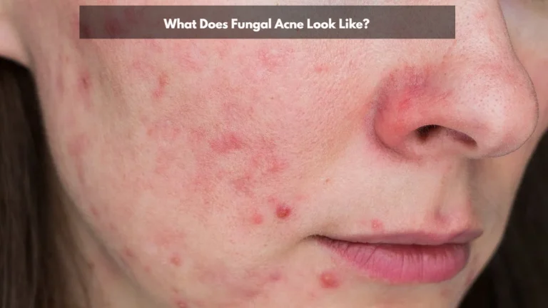 Fungal Acne: Symptoms, Facts & Best Treatment Options