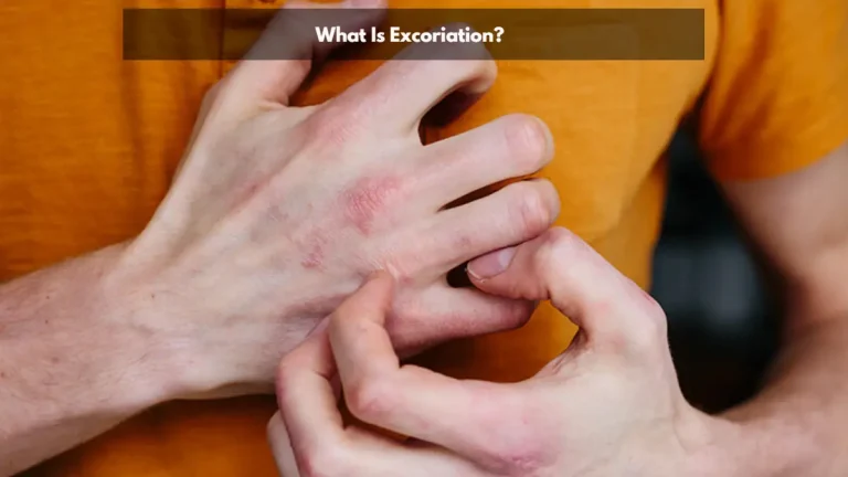 7 Ways to Treat Excoriation Disorder (Dermatillomania)