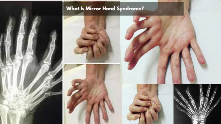 Mirror Hand Syndrome: Causes, Symptoms, and Treatment