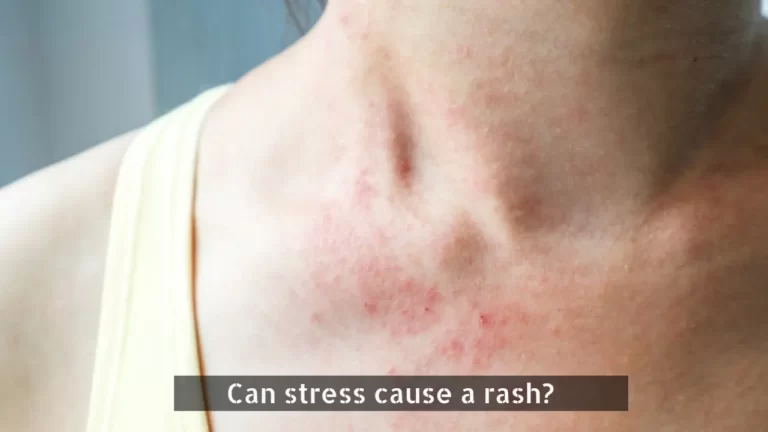 Stress Face and Hand Rash: Causes & Treatment Options