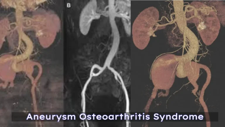 Aneurysm Osteoarthritis Syndrome: Key Facts & Insights