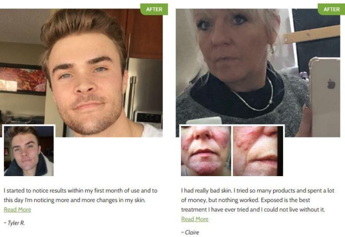 Exposed Skin Care Reviews: Shocking Customer Results
