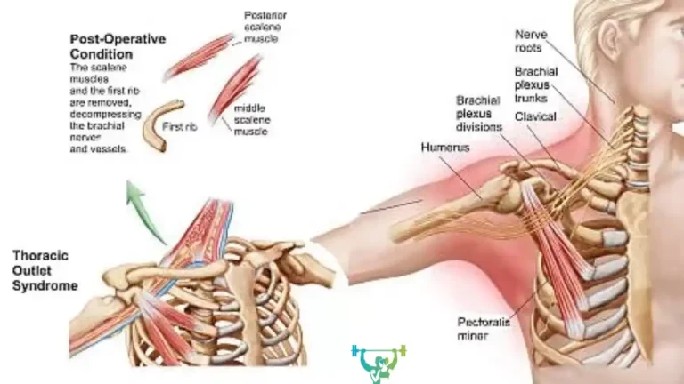 7 Best Exercises for Thoracic Outlet Syndrome Relief